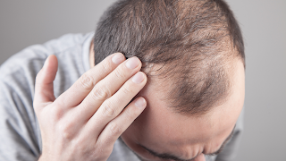 An Unprecedented Leap in the Treatment of Hair Loss: Inject-Away Baldness!