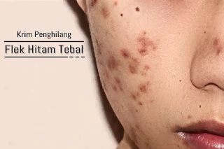 Cream Penghilang Flek Hitam Tebal Yang Ada di Apotik