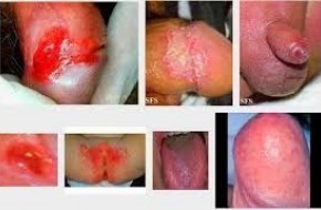 http://obatsipilis-tradisional.blogspot.co.id/2015/10/obat-sipilis-terpercaya-sembuh-3-5-hari.html