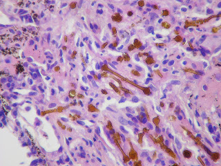 Mesothelioma of the Peritoneum