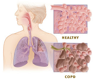 Nursing  Management of COPD