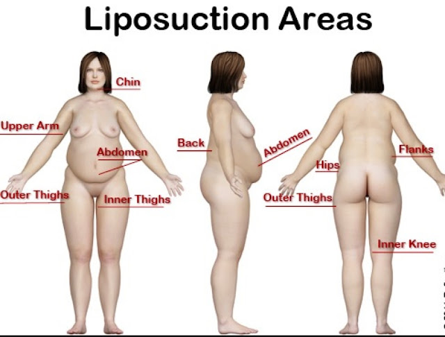 Area to be undergo liposuction method