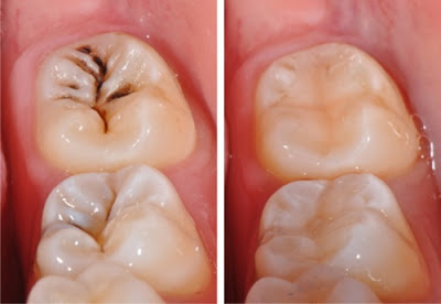 Bà bầu hàn răng có nguy hiểm không?