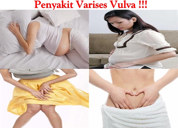 Obat Tradisional Varises Vulva