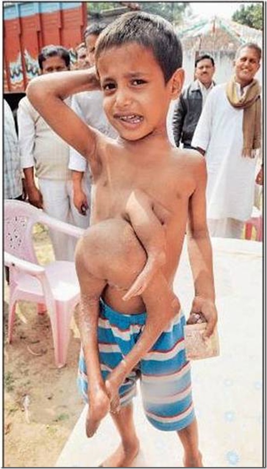 India´s octo-limbo kid wants help