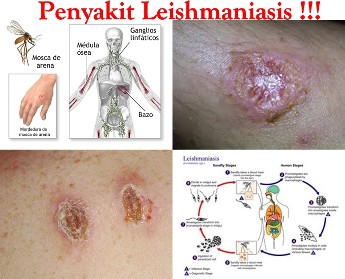 Obat Tradisional Leishmaniasis