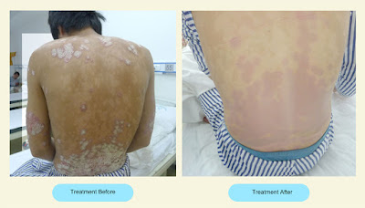 Psoriasis Scalp Pictures Treatment Options