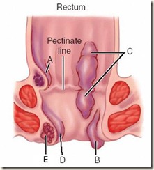 external and internal hemorrhoids