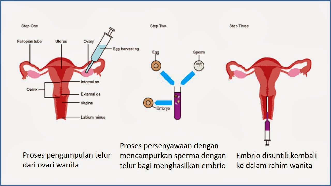 Hisemudin Kasim: Teknik penghamilan luar rahim IVF 