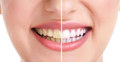 Xử lý răng ố vàng và có cao răng bảo vệ răng miệng 2