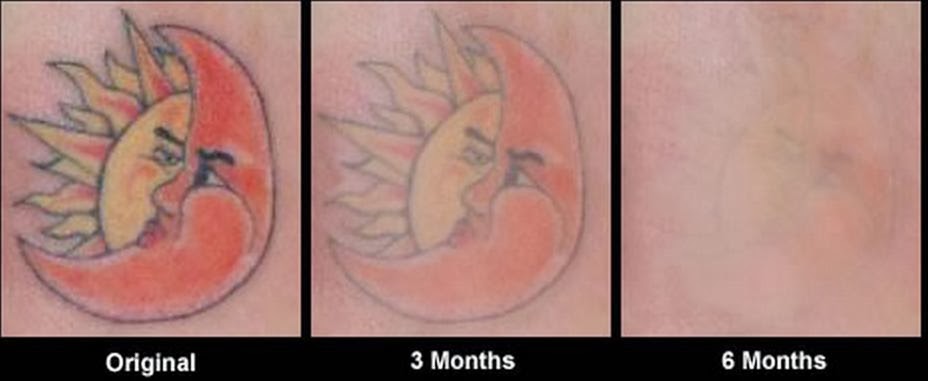 tattoo removal cream, before and after photos of tattoo removal cream ...