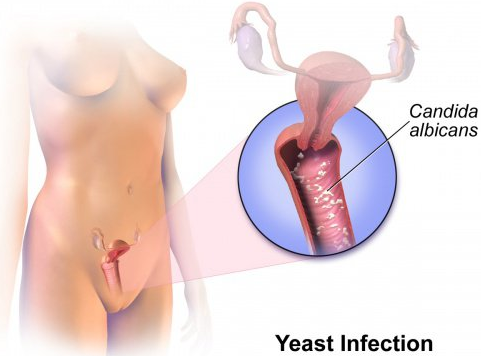 Reliable Treatment for Yeast Infection