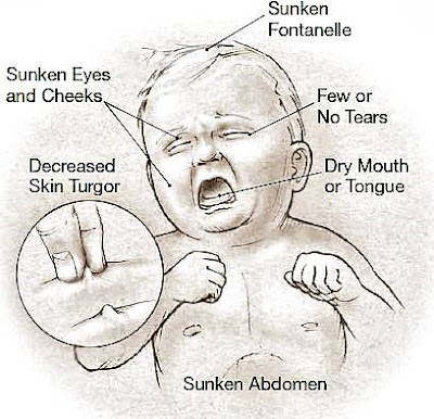 APA ITU JANGKITAN ROTAVIRUS?  SIMPTOM & CARA MENGATASI 