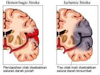 TANDA-TANDA STROK DAN CADANGAN SUPPLEMENT