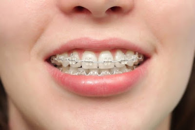 Kỹ thuật niềng răng nhanh là như thế nào?