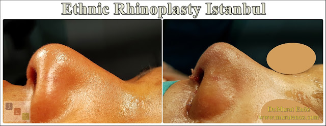 Ethnic Rhinoplasty Istanbul – Dr.Murat Enoz – Nose job in Istanbul – Nose surgery in Istanbul – Nose job in Turkey - Ethnic rhinoplasty Turkey - Ethnic rhinoplasty in Turkey - African American rhinoplasty - Ethnic expert nose job surgeon - Rhinoplasty surgeon in Istanbul - Black nose job - Rhinoplasty for ethnic nose - Rhinoplasty for African people - African American nose surgery – Rhinoplasty for African American Nose - Thick skin rhinoplasty - Rhinoplasty in istanbul