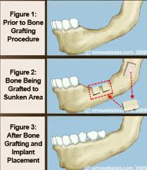 All on 4 dental implants