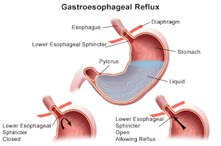 asam lambung (GERD)