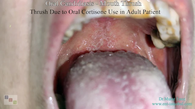 Oral candidiasis, Mouth thrush, Candida infection of soft palate,Oral thrush, Yeast infection in mouth