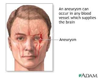 Information About Brain Aneurysm