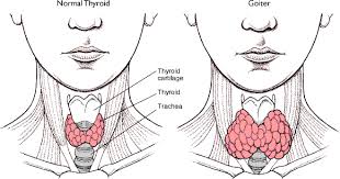 Goiter Causes a Symptoms and Treatment