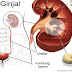 Pengobatan Alternatif Batu Ginjal dan Kencing Batu