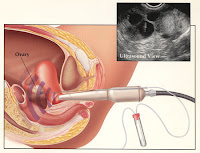 Is It Okay For You To Grab IVF After Ovarian Cancer Treatment ?, Ovary, Ovarian Cancer, article