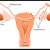  Pengertian dan Penyebab Penyakit - Pengertian Penyakit Endometriosis, Gejala, Penyebab dan Pengobatan- TodaysDandy
