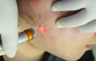 how to eliminate acne with laser