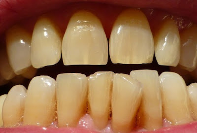 Nguyên nhân răng bị nhiễm màu tetracycline