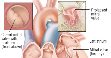 regurgitasi mitral