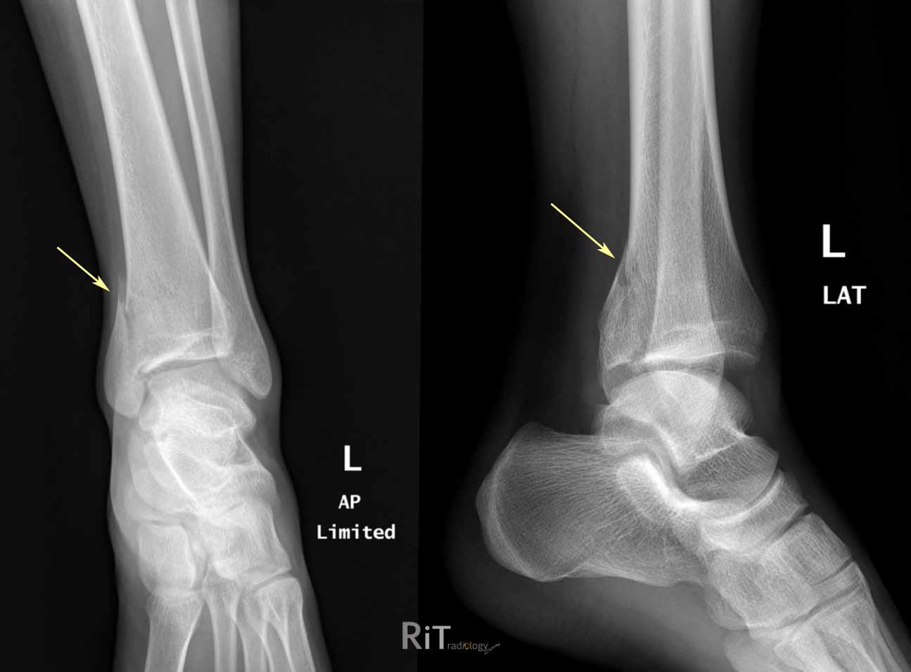 Rit Radiology Maisonneuve Fracture