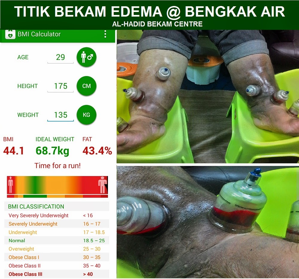 AL-HADID BEKAM CENTRE: PESAKIT OBESITI EDEMA