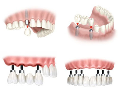 dòng răng sứ phục hình trên răng