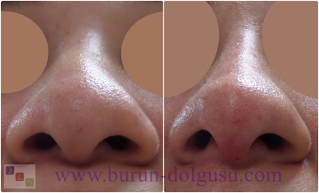 Non-surgical nose job - Non surgical nose job with filler in İstanbul - Non-surgical rhinoplasty in İstanbul - Nose tip filler augmentation in İstanbul - Non-surgical rhinoplasty in İstanbul - Nose filler injection in Turkey - The 5 Minute Nose Job in İstanbul, Turkey - Non-surgical nose job in Istanbul - Non-surgical nose job istanbul - Nose filler injection Turkey - Injectable nose job - Liquid rhinoplasty