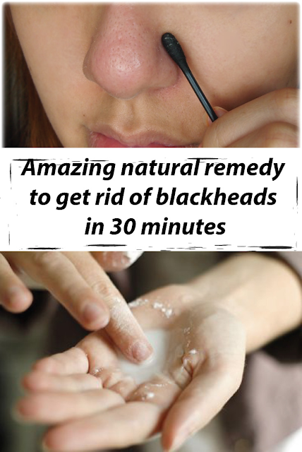 Amazing natural remedy to get rid of blackheads in 30 minutes