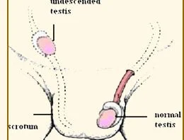 Causes-disappearance-testicle-treatment