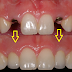 Cấy ghép implant cho răng hàm