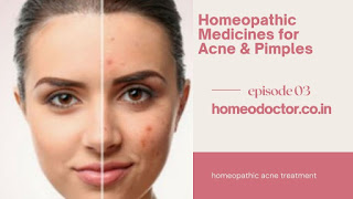 Homeopathic medicines for acne and pimples