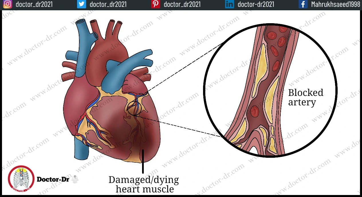Myocardial Infarction- (Heart Attack)