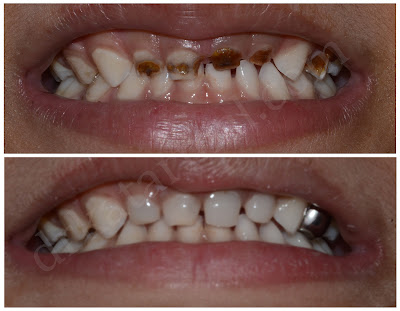 Treatment of Front Milk Teeth Decay