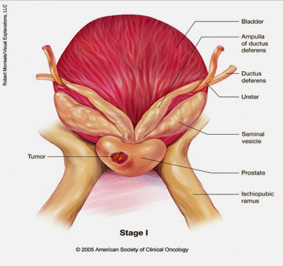Stage I (stage A) Prostate cancer
