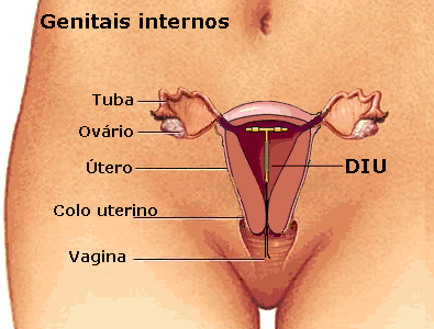 O engano do DIU ele mata o embrião e causa doenças veja