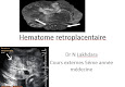 Hematome retroplacentaire Dr N Lakhdara