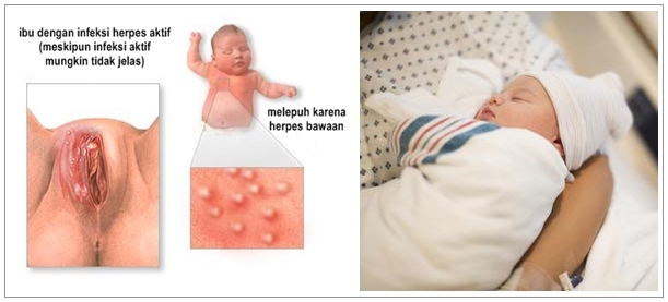 Pengobatan Herbal Herpes Pada Bayi Baru Lahir