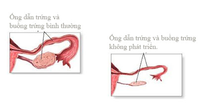 triệu chứng bệnh suy buồng trứng