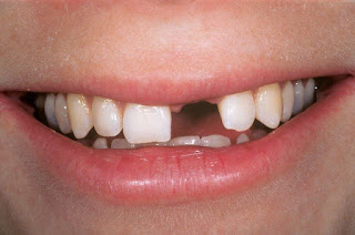 Gãy răng có mọc lại không, nên làm cách nào là tốt nhất? Gãy răng có mọc lại không, nên làm cách nào là tốt nhất?