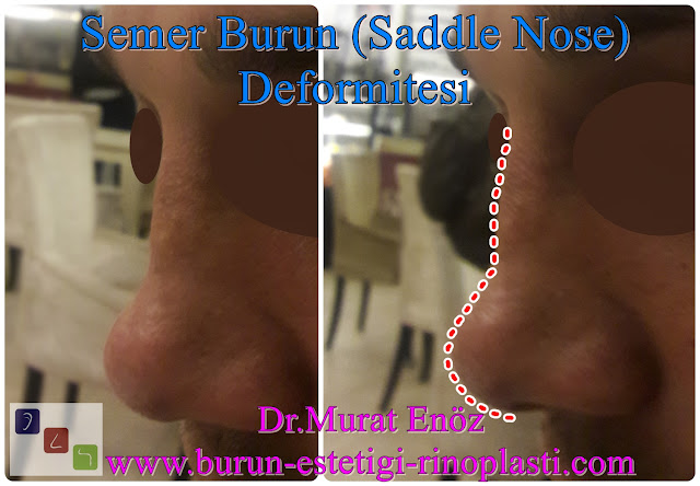 Semer burun deformitesi nedir? - Semer burun nedenleri - Semer burun tedavisi - Saddle nose nedir? - Saddle nose anlamı - Semer burun ameliyatı