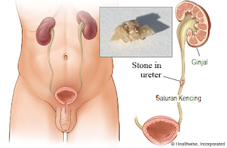 cara menghancurkan batu ginjal tanpa operasi,obat batu ginjal,obat kencing batu,cara mengeluarkan batu ginjal tanpa operasi,cara menghilangkan batu ginjal tanpa operasi
