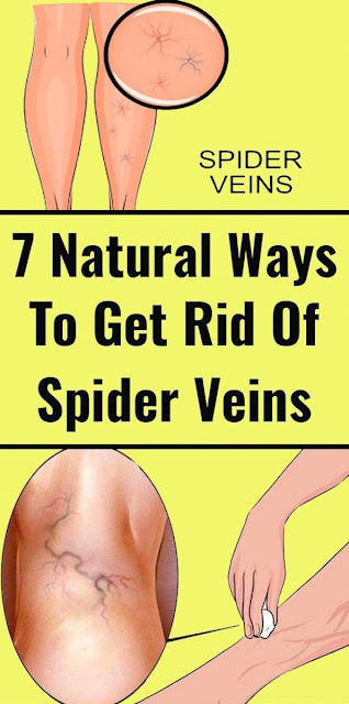 Get Rid Of Spider Veins In These 7 Natural Methods
